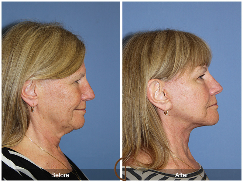 Female Facelift  Before & After Image