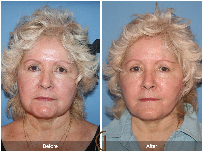 Female Facelift  Before & After Image