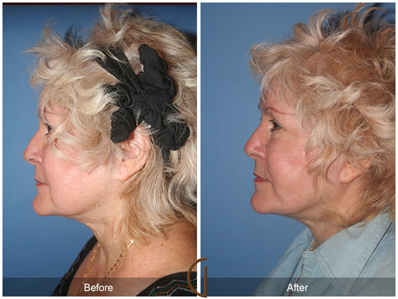 Female Facelift  Before & After Image