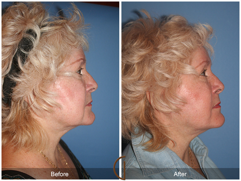 Female Facelift  Before & After Image