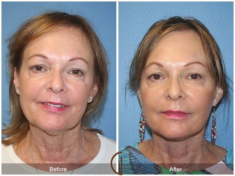 Female Facelift  Before & After Image