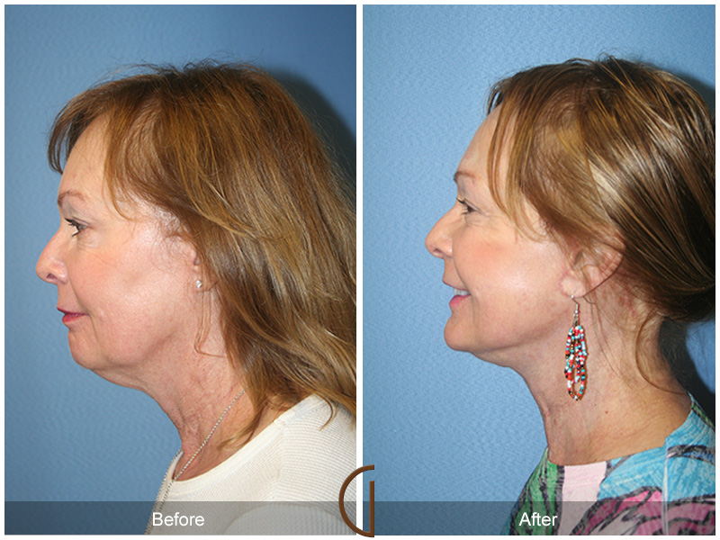 Female Facelift  Before & After Image