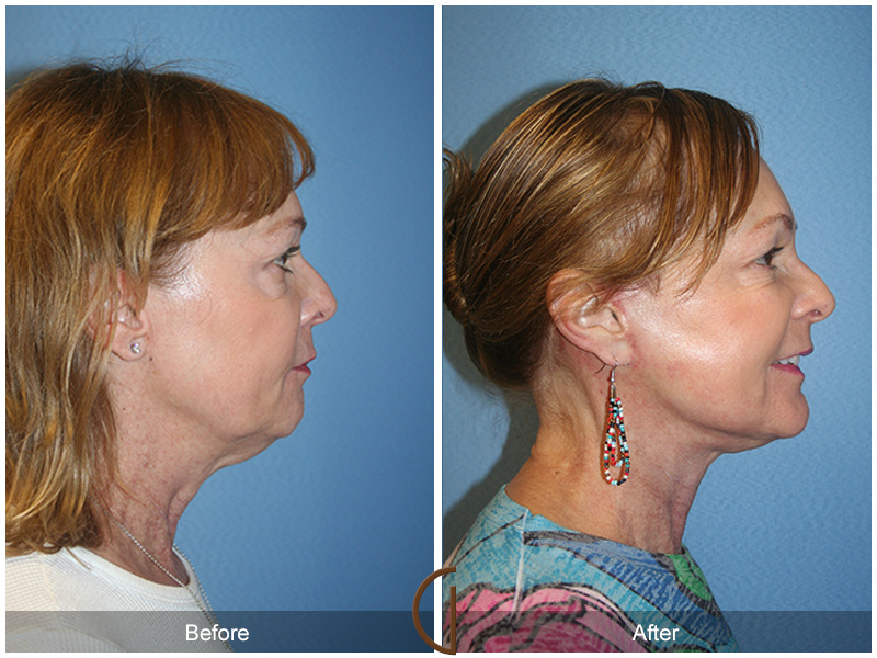 Female Facelift  Before & After Image