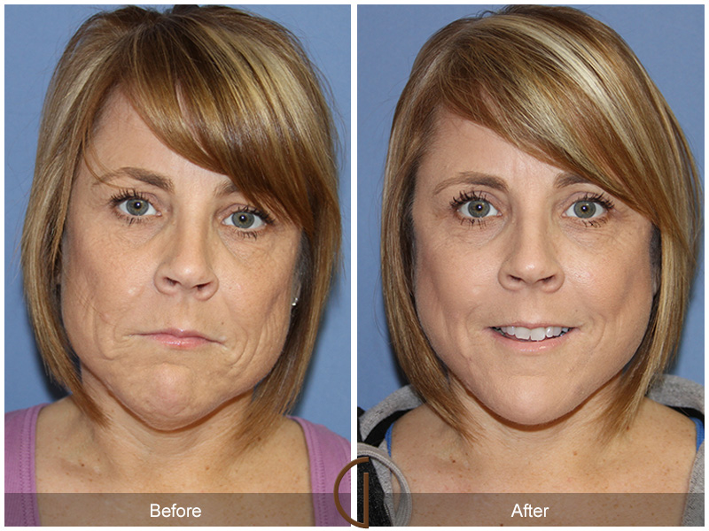 Female Facelift  Before & After Image