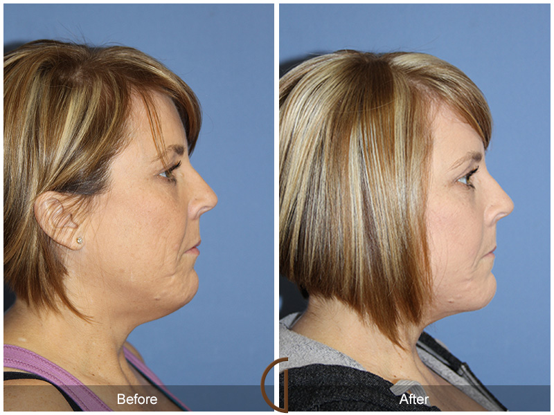 Female Facelift  Before & After Image