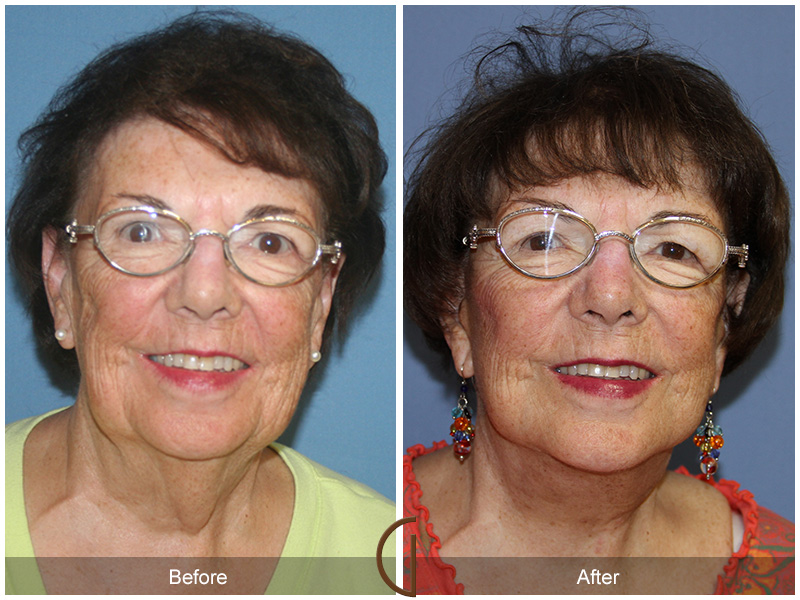 Female Facelift  Before & After Image