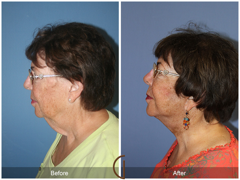 Female Facelift  Before & After Image