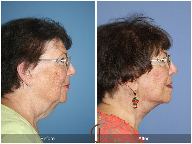 Female Facelift  Before & After Image