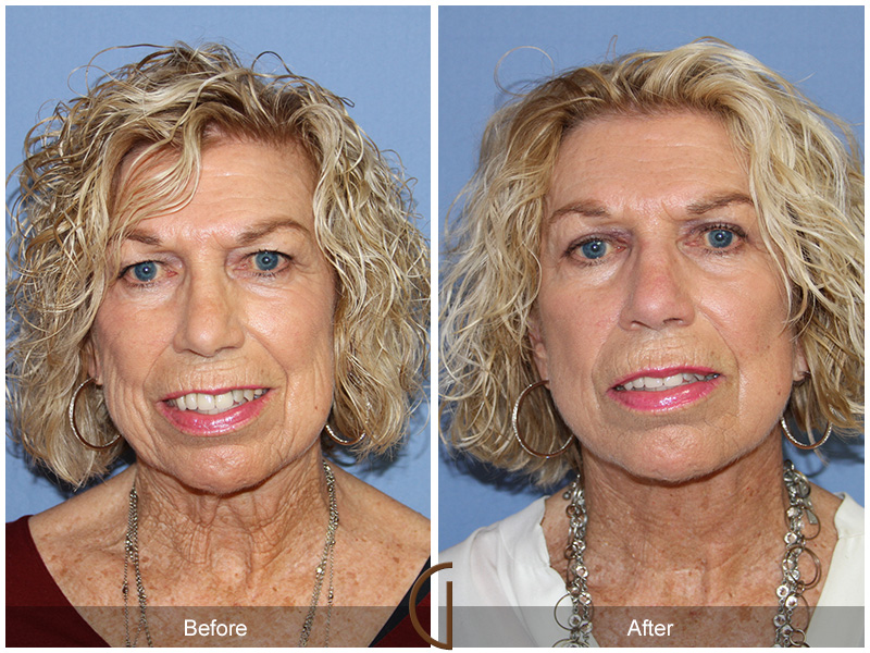 Female Facelift  Before & After Image