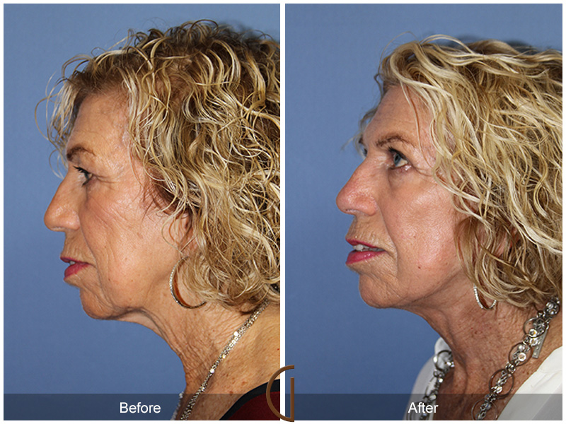 Female Facelift  Before & After Image