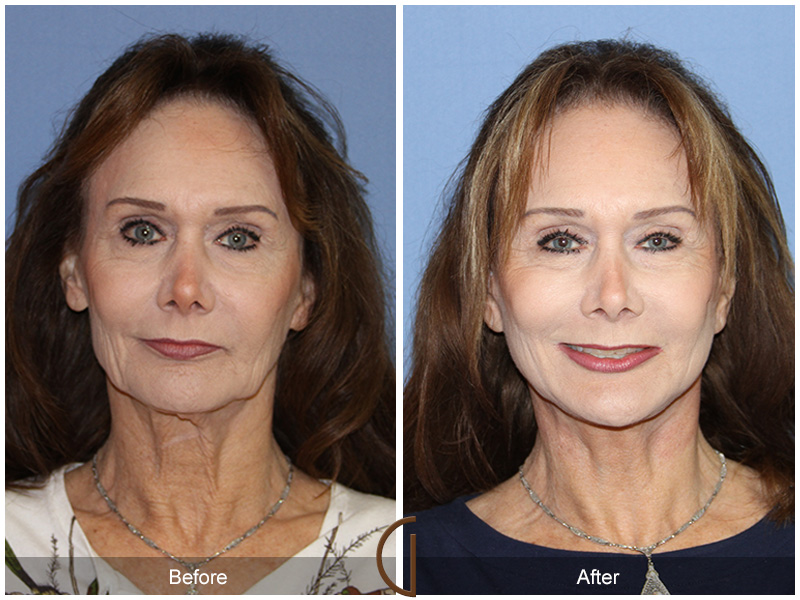 Female Facelift  Before & After Image