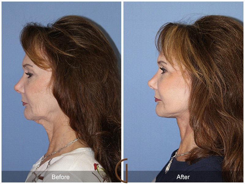 Female Facelift  Before & After Image