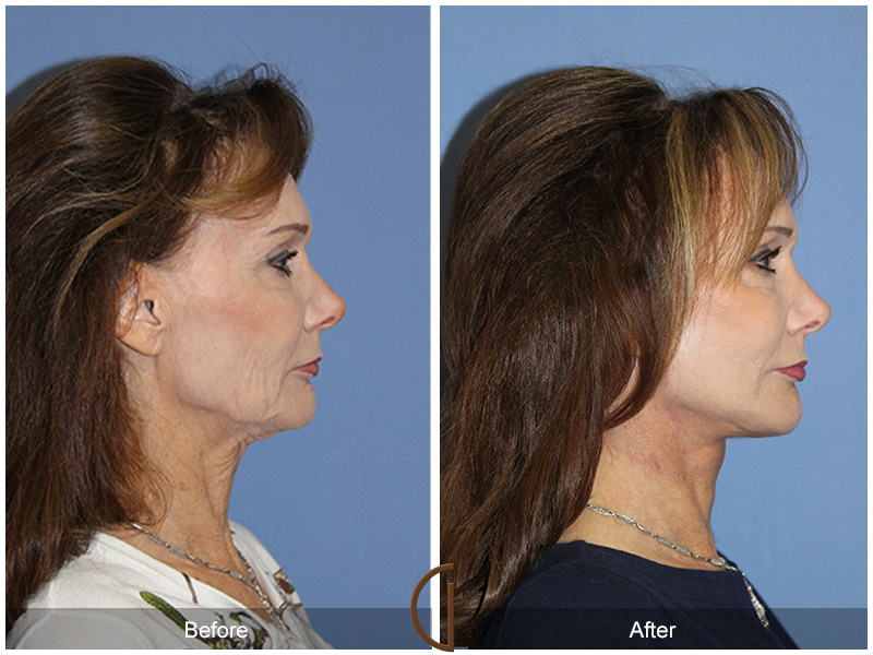 Female Facelift  Before & After Image