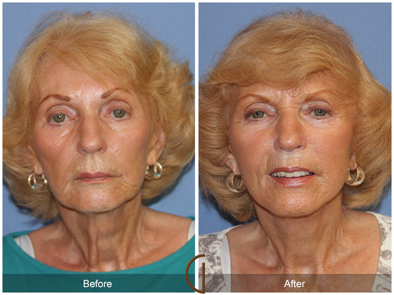 Female Facelift  Before & After Image