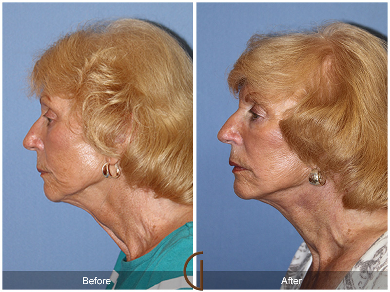 Female Facelift  Before & After Image