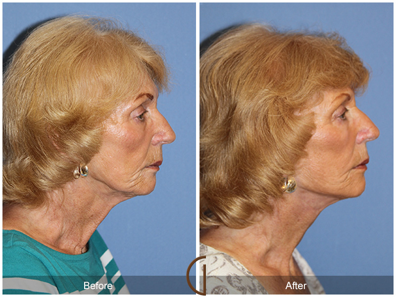 Female Facelift  Before & After Image