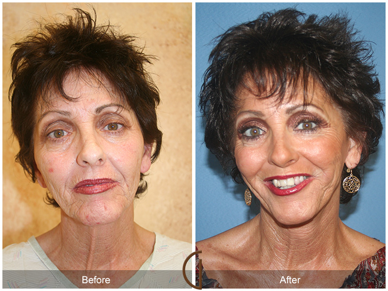 Female Facelift  Before & After Image