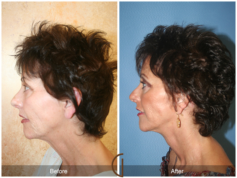 Female Facelift  Before & After Image