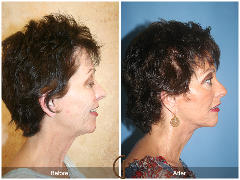 Female Facelift  Before & After Image