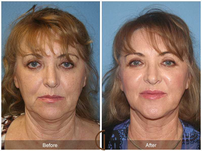 Female Facelift  Before & After Image