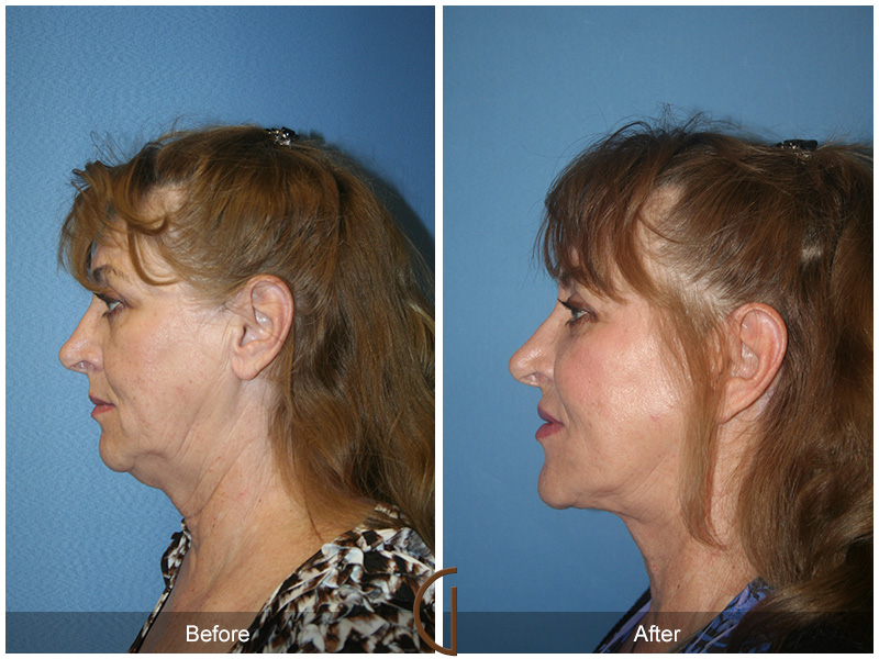 Female Facelift  Before & After Image