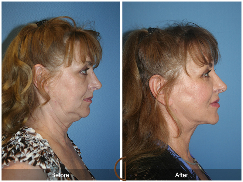 Female Facelift  Before & After Image