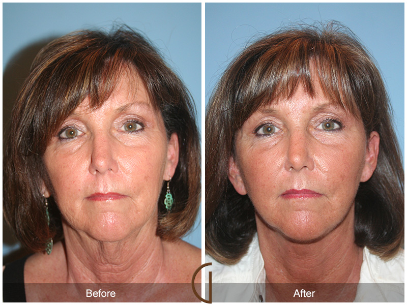 Female Facelift  Before & After Image