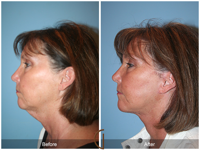 Female Facelift  Before & After Image