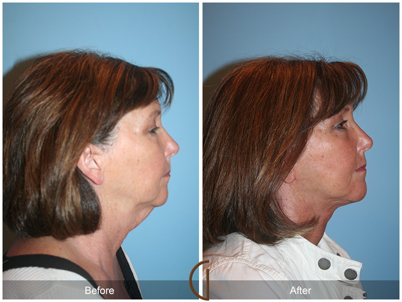 Female Facelift  Before & After Image