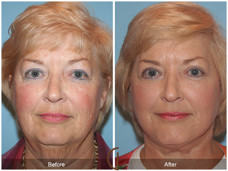 Female Facelift  Before & After Image