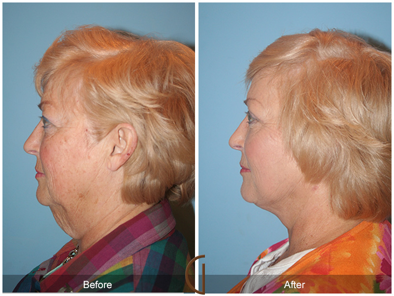 Female Facelift  Before & After Image