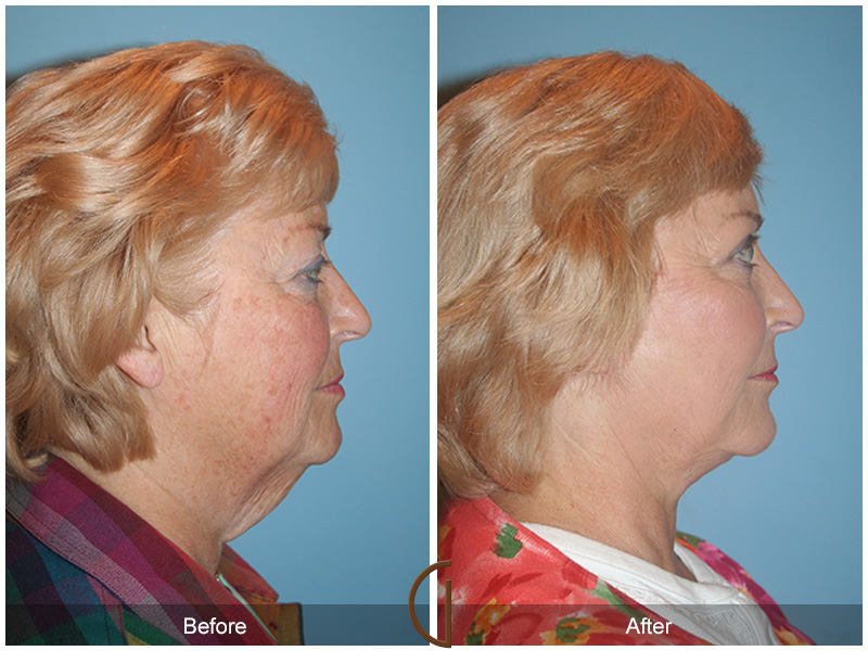 Female Facelift  Before & After Image