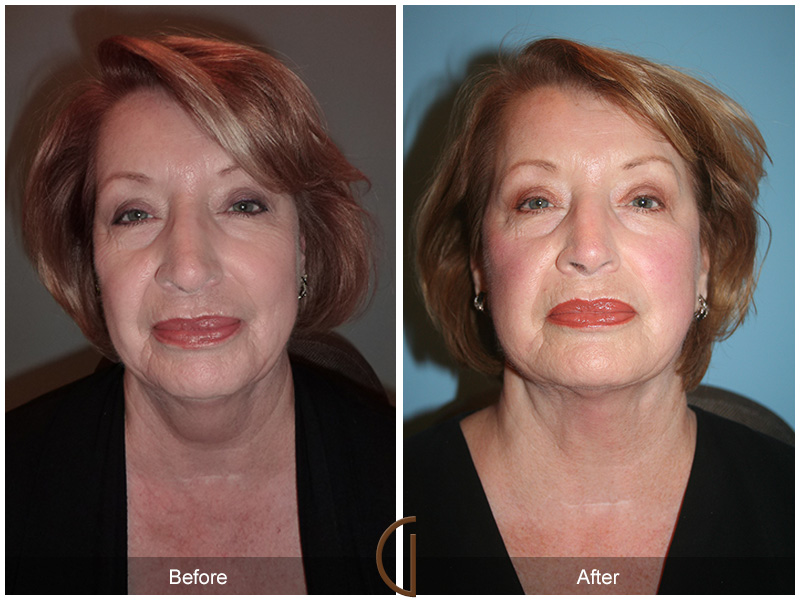 Female Facelift  Before & After Image