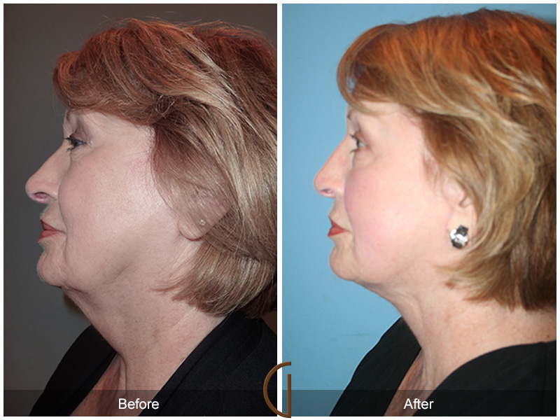 Female Facelift  Before & After Image