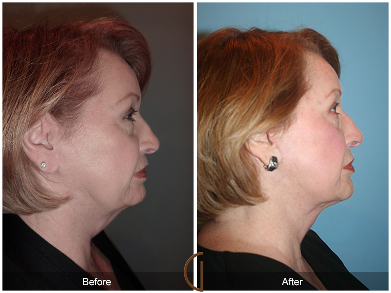 Female Facelift  Before & After Image