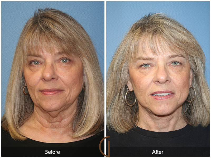 Female Facelift  Before & After Image