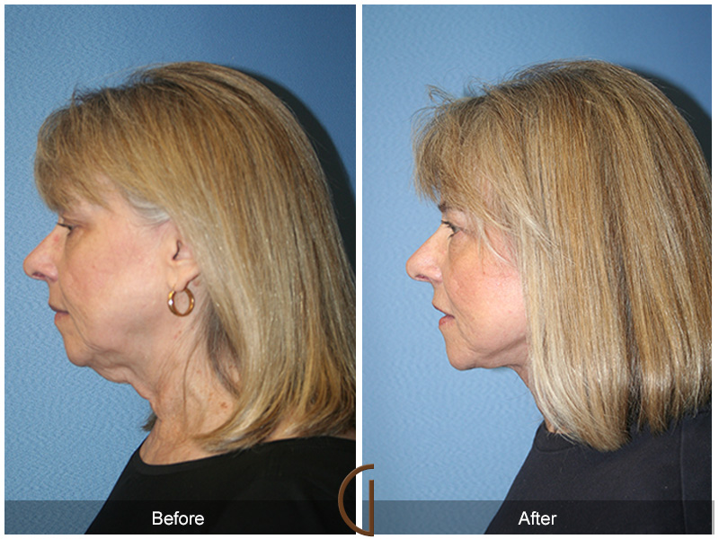 Female Facelift  Before & After Image