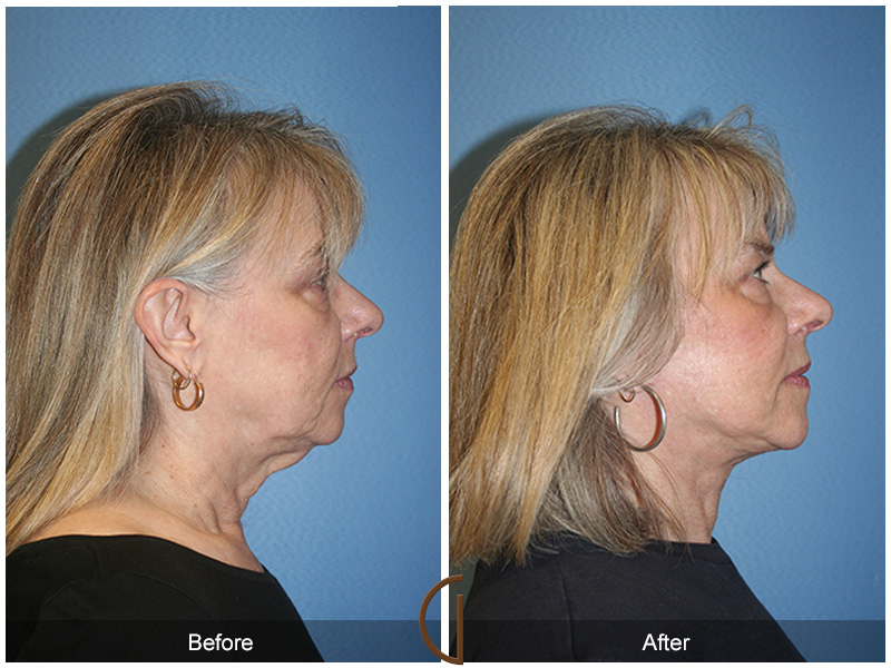 Female Facelift  Before & After Image