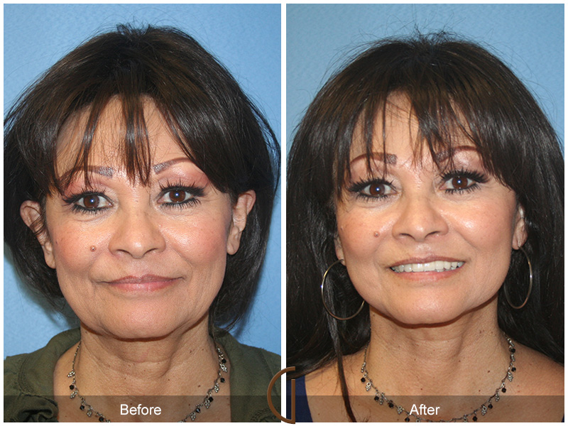 Female Facelift  Before & After Image