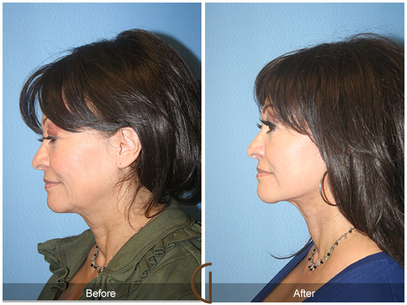 Female Facelift  Before & After Image