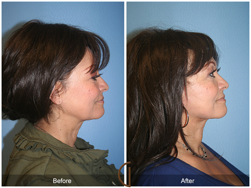 Female Facelift  Before & After Image