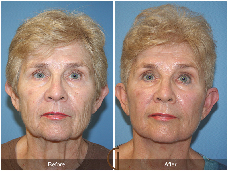 Female Facelift  Before & After Image