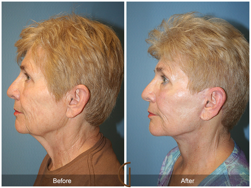 Female Facelift  Before & After Image