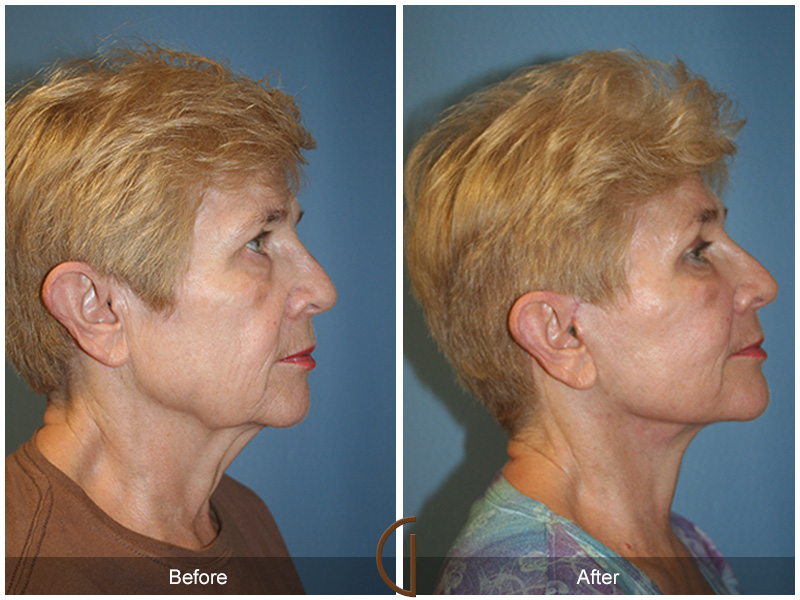 Female Facelift  Before & After Image