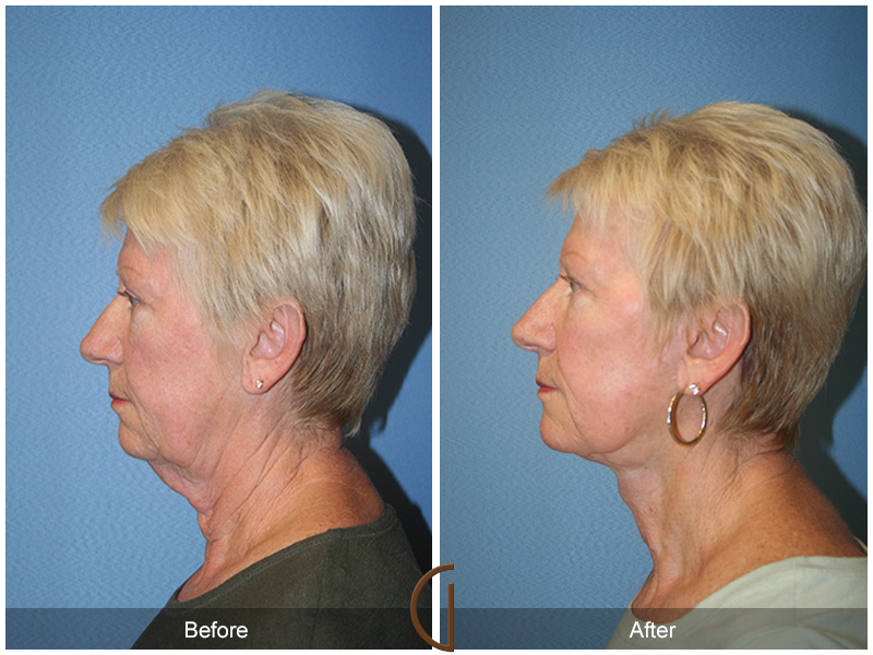 Female Facelift  Before & After Image