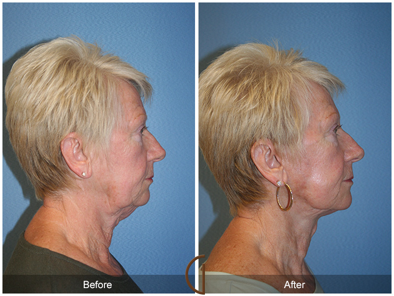 Female Facelift  Before & After Image