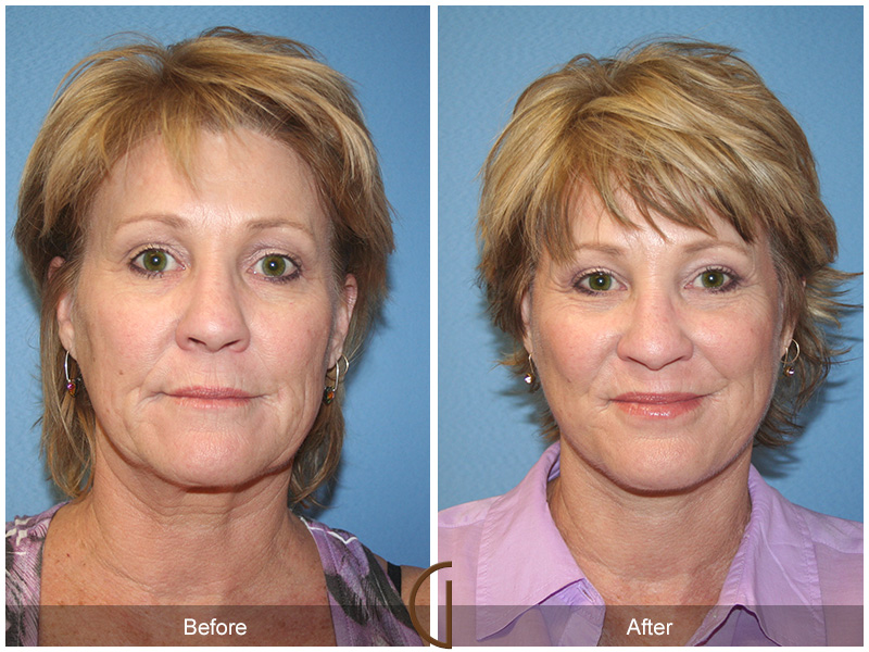 Female Facelift  Before & After Image