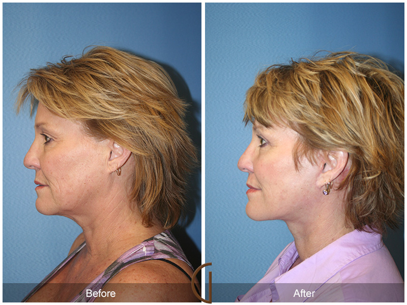 Female Facelift  Before & After Image