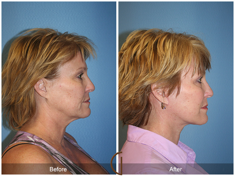 Female Facelift  Before & After Image