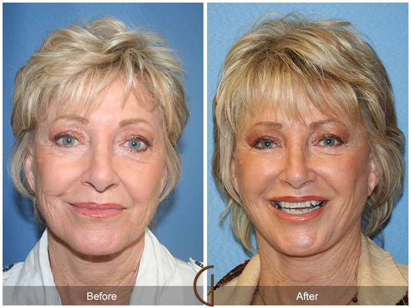 Female Facelift  Before & After Image